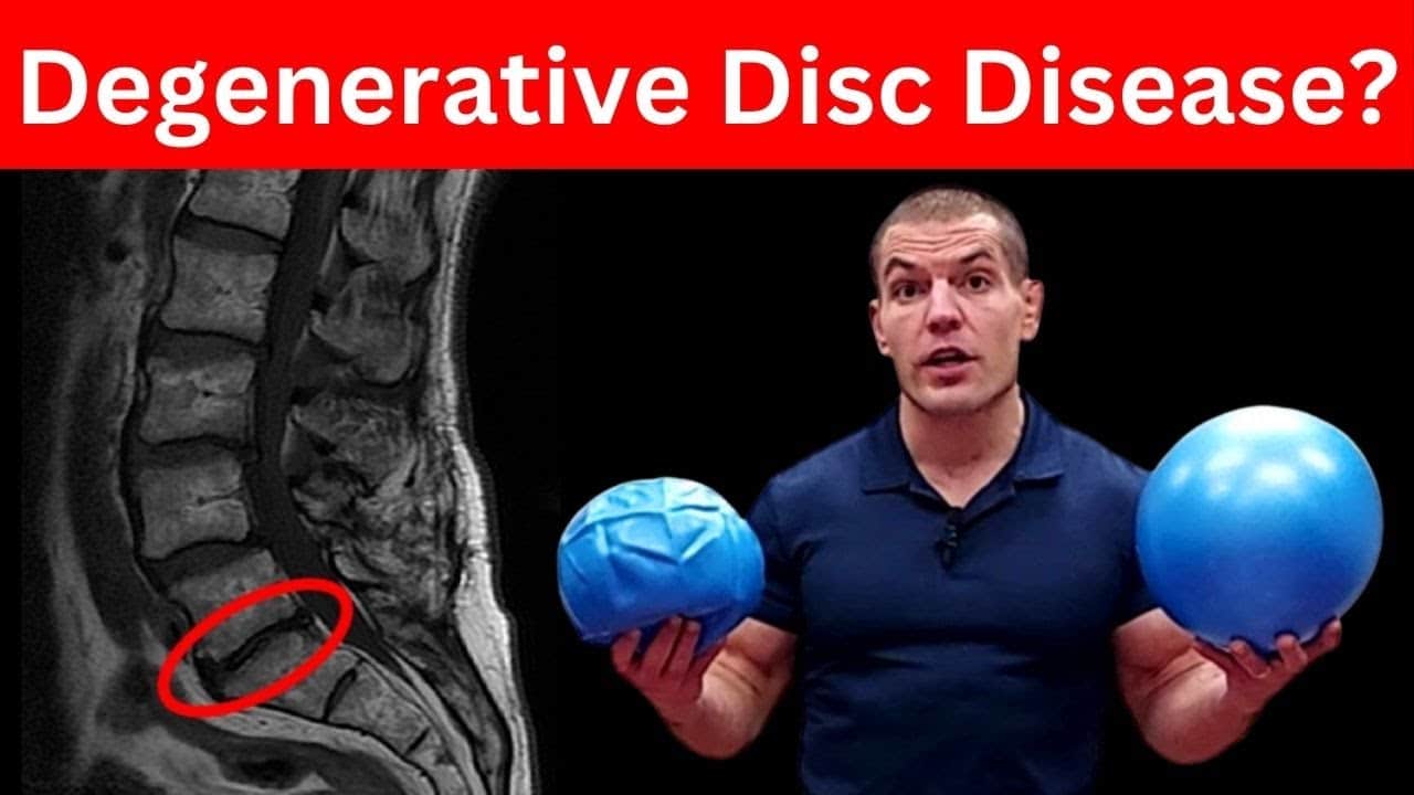 4 Essential Exercises for Degenerative Discs in Lower Back