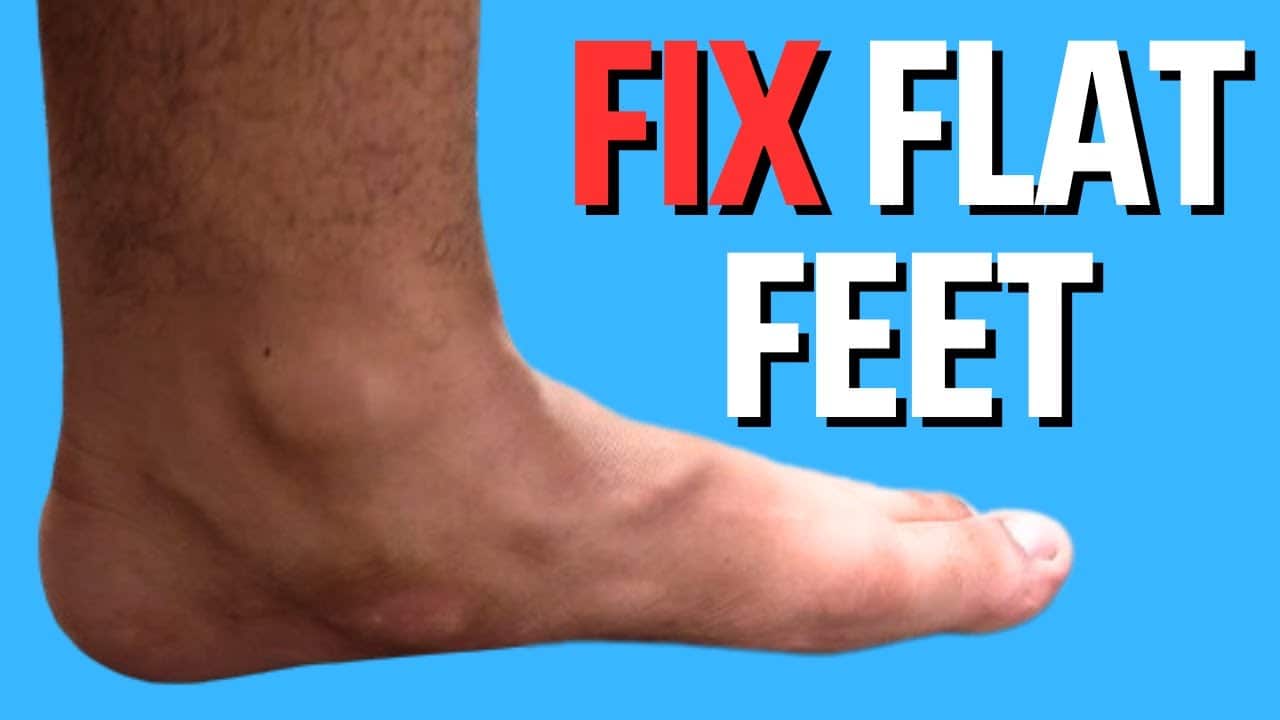 How to Fix Flat Feet and Fallen Arches Effectively