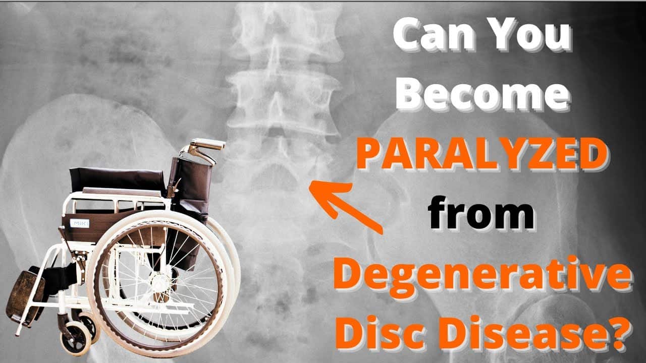 Can You Become Paralyzed From Degenerative Disc Disease?