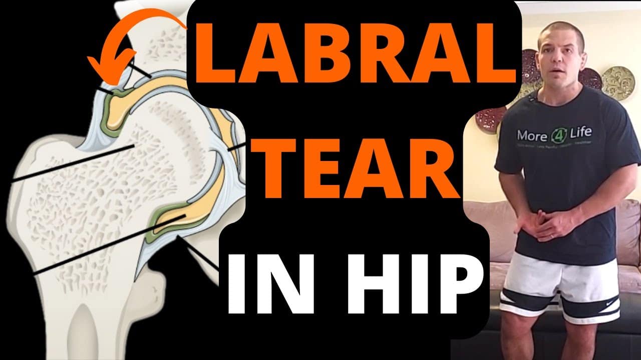 Labral Tear in Hip: Symptoms, Treatment, and Exercises