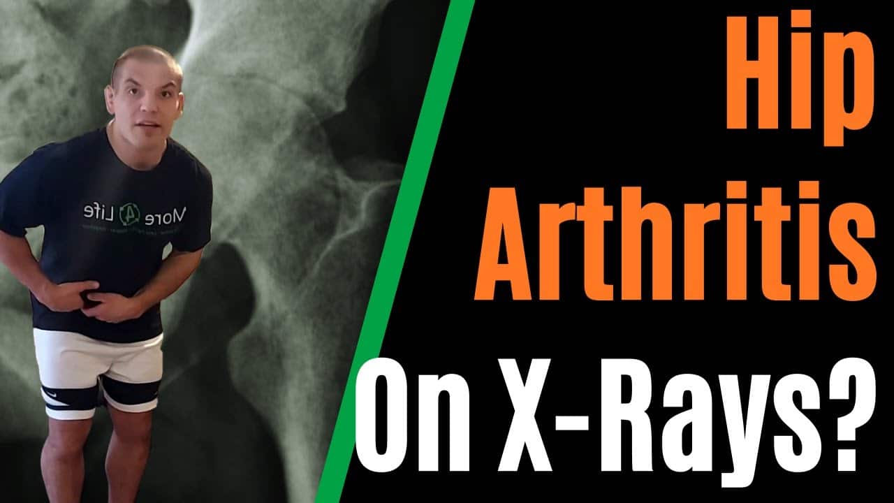 Understanding Hip Pain with Arthritis and How to Alleviate It